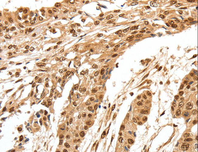 SPATA20 Antibody - Immunohistochemistry of paraffin-embedded Human esophagus cancer using SPATA20 Polyclonal Antibody at dilution of 1:70.