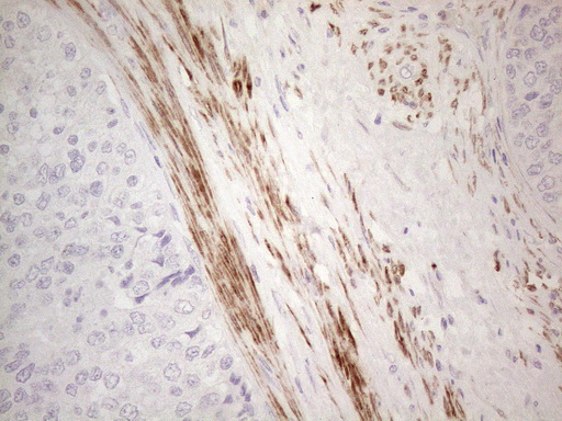 SPATA22 Antibody - Immunohistochemical staining of paraffin-embedded Adenocarcinoma of Human endometrium tissue using anti-SPATA22 mouse monoclonal antibody. (Heat-induced epitope retrieval by 1mM EDTA in 10mM Tris buffer. (pH8.5) at 120°C for 3 min. (1:150)