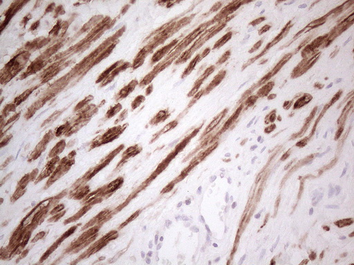 SPATA22 Antibody - Immunohistochemical staining of paraffin-embedded Carcinoma of Human prostate tissue using anti-SPATA22 mouse monoclonal antibody. (Heat-induced epitope retrieval by 1mM EDTA in 10mM Tris buffer. (pH8.5) at 120°C for 3 min. (1:150)