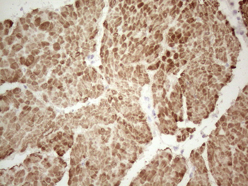 SPATA22 Antibody - Immunohistochemical staining of paraffin-embedded Carcinoma of Human bladder tissue using anti-SPATA22 mouse monoclonal antibody. (Heat-induced epitope retrieval by 1mM EDTA in 10mM Tris buffer. (pH8.5) at 120°C for 3 min. (1:150)