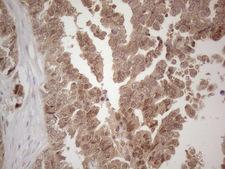 SPATA22 Antibody - Immunohistochemical staining of paraffin-embedded Adenocarcinoma of Human ovary tissue using anti-SPATA22 mouse monoclonal antibody. (Heat-induced epitope retrieval by 1mM EDTA in 10mM Tris buffer. (pH8.5) at 120°C for 3 min. (1:150)