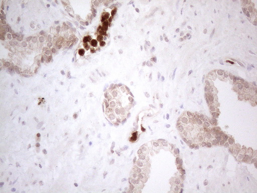 SPATA22 Antibody - Immunohistochemical staining of paraffin-embedded Carcinoma of Human prostate tissue using anti-SPATA22 mouse monoclonal antibody. (Heat-induced epitope retrieval by 1mM EDTA in 10mM Tris buffer. (pH8.5) at 120°C for 3 min. (1:150)