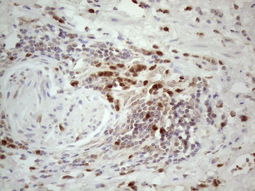 SPATA22 Antibody - Immunohistochemical staining of paraffin-embedded Carcinoma of Human bladder tissue using anti-SPATA22 mouse monoclonal antibody. (Heat-induced epitope retrieval by 1mM EDTA in 10mM Tris buffer. (pH8.5) at 120°C for 3 min. (1:150)
