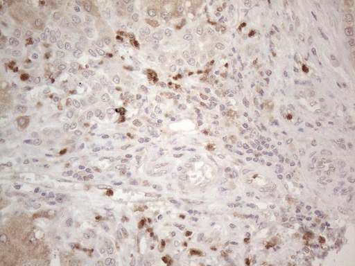 SPATA22 Antibody - Immunohistochemical staining of paraffin-embedded Carcinoma of Human liver tissue using anti-SPATA22 mouse monoclonal antibody. (Heat-induced epitope retrieval by 1mM EDTA in 10mM Tris buffer. (pH8.5) at 120°C for 3 min. (1:150)