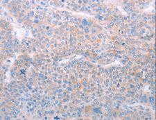 SPATA6 / SRF-1 Antibody - Immunohistochemistry of paraffin-embedded Human lung cancer using SPATA6 Polyclonal Antibody at dilution of 1:50.
