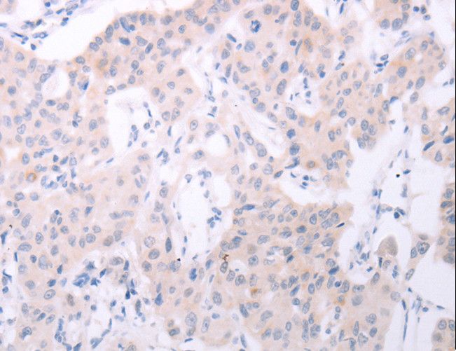 SPATA6 / SRF-1 Antibody - Immunohistochemistry of paraffin-embedded Human lung cancer using SPATA6 Polyclonal Antibody at dilution of 1:50.