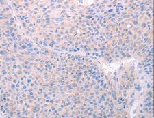 SPATA6 / SRF-1 Antibody - Immunohistochemistry of paraffin-embedded Human liver cancer using SPATA6 Polyclonal Antibody at dilution of 1:40.
