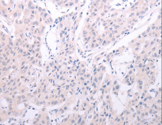 SPATA6 / SRF-1 Antibody - Immunohistochemistry of paraffin-embedded Human lung cancer using SPATA6 Polyclonal Antibody at dilution of 1:40.