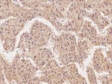 SPATA6 / SRF-1 Antibody - Immunochemical staining of human SPATA6 in human hepatoma with rabbit polyclonal antibody at 1:100 dilution, formalin-fixed paraffin embedded sections.