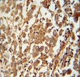 SPATC1 Antibody - SPATC1 antibody immunohistochemistry of formalin-fixed and paraffin-embedded human testis carcinoma followed by peroxidase-conjugated secondary antibody and DAB staining.