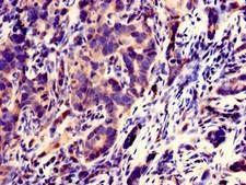 SPATC1L / C21orf56 Antibody - Immunohistochemistry of paraffin-embedded human pancreatic cancer using SPATC1L Antibody at dilution of 1:100