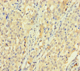 SPATS1 Antibody - Immunohistochemistry of paraffin-embedded human lung cancer using SPATS1 Antibody at dilution of 1:100