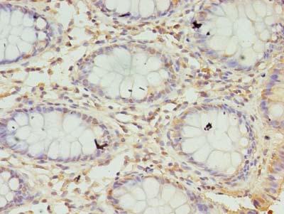 SPC18 / SEC11A Antibody - Immunohistochemistry of paraffin-embedded human colon cancer using antibody at dilution of 1:100.