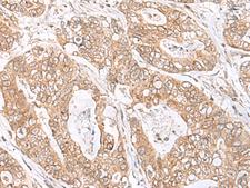 SPC18 / SEC11A Antibody - Immunohistochemistry of paraffin-embedded Human gastric cancer tissue  using SEC11A Polyclonal Antibody at dilution of 1:45(×200)