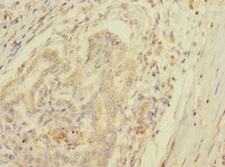 SPC25 Antibody - Immunohistochemistry of paraffin-embedded human pancreatic cancer using SPC25 Antibody at dilution of 1:100