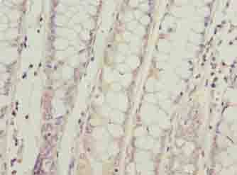 SPCS2 Antibody - Immunohistochemistry of paraffin-embedded human colon cancer using antibody at dilution of 1:100.