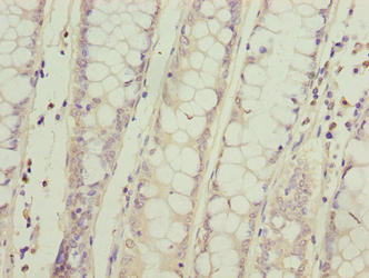 SPCS2 Antibody - Immunohistochemistry of paraffin-embedded human colon cancer using SPCS2 Antibody at dilution of 1:100