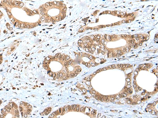 SPCS2 Antibody - Immunohistochemistry of paraffin-embedded Human gastric cancer tissue  using SPCS2 Polyclonal Antibody at dilution of 1:40(×200)