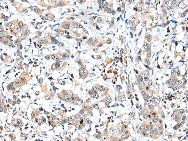 SPCS2 Antibody - Immunohistochemistry of paraffin-embedded Human breast cancer tissue  using SPCS2 Polyclonal Antibody at dilution of 1:40(×200)