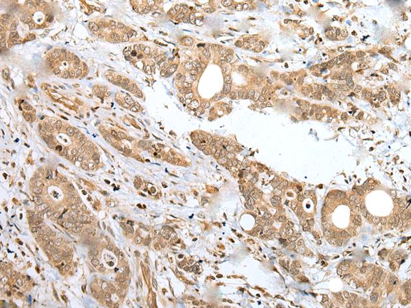 SPCS2 Antibody - Immunohistochemistry of paraffin-embedded Human gastric cancer tissue  using SPCS2 Polyclonal Antibody at dilution of 1:35(×200)