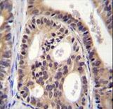 SPECC1L Antibody - CYTSA Antibody immunohistochemistry of formalin-fixed and paraffin-embedded human prostate carcinoma followed by peroxidase-conjugated secondary antibody and DAB staining.