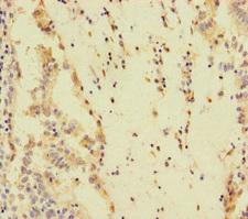 SPEM1 Antibody - Immunohistochemistry of paraffin-embedded human lung cancer using SPEM1 Antibody at dilution of 1:100