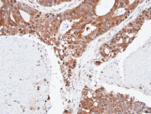 SPFH2 / ERLIN2 Antibody - IHC of paraffin-embedded endo mitral OVCA using ERLIN2 antibody at 1:100 dilution.