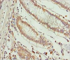 SPFH2 / ERLIN2 Antibody - Immunohistochemistry of paraffin-embedded human colon cancer at dilution 1:100