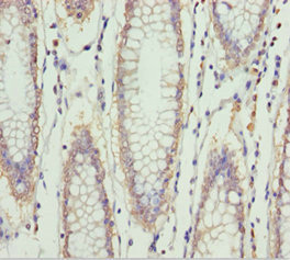 SPFH2 / ERLIN2 Antibody - Immunohistochemistry of paraffin-embedded human colon cancer at dilution 1:100