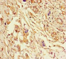 SPFH2 / ERLIN2 Antibody - Immunohistochemistry of paraffin-embedded human pancreatic cancer at dilution of 1:100