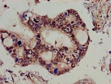 SPG21 / MAST Antibody - Immunohistochemistry of paraffin-embedded human pancreatic cancer using SPG21 Antibody at dilution of 1:100