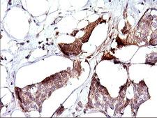 SPHK / SPHK1 Antibody - IHC of paraffin-embedded Adenocarcinoma of Human breast tissue using anti-SPHK1 mouse monoclonal antibody. (Heat-induced epitope retrieval by 1 mM EDTA in 10mM Tris, pH8.5, 120°C for 3min).