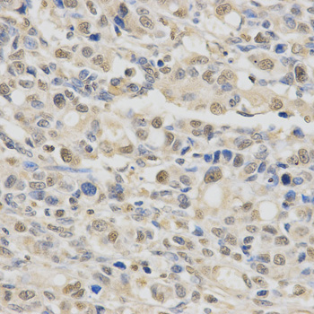 SPHK / SPHK1 Antibody - Immunohistochemistry of paraffin-embedded human gastric cancer using SPHK1 Antibodyat dilution of 1:200 (40x lens).