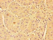 SPHK / SPHK1 Antibody - Immunohistochemistry of paraffin-embedded human liver cancer tissue using SPHK1 Antibody at dilution of 1:100