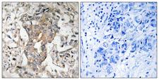 SPHK2 Antibody - Immunohistochemistry analysis of paraffin-embedded human breast carcinoma tissue, using SPHK2 Antibody. The picture on the right is blocked with the synthesized peptide.