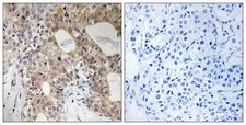 SPHK2 Antibody - Immunohistochemistry analysis of paraffin-embedded human breast carcinoma, using SPHK2 (Phospho-Thr614) Antibody. The picture on the right is blocked with the phospho peptide.