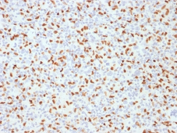 SPI1 / PU.1 Antibody - IHC staining of FFPE Hodgkins lymphoma with SOX9 antibody (clone PU1/2146). HIER: boil tissue sections in pH6, 10mM citrate buffer, for 10-20 min followed by cooling at RT for 20 min.