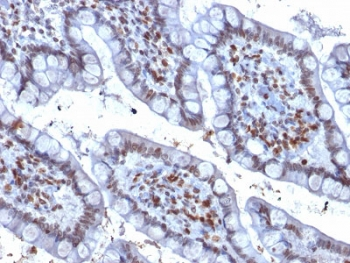 SPI1 / PU.1 Antibody - IHC staining of FFPE human colon carcinoma with SOX9 antibody (clone PU1/2146). HIER: boil tissue sections in pH6, 10mM citrate buffer, for 10-20 min followed by cooling at RT for 20 min.