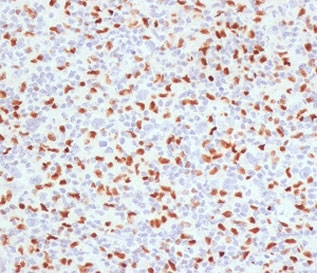 SPI1 / PU.1 Antibody - IHC staining of FFPE human Hodgkins lymphoma with SOX9 antibody (clone TFPU1-1). HIER: boil tissue sections in pH6, 10mM citrate buffer, for 10-20 min followed by cooling at RT for 20 min.