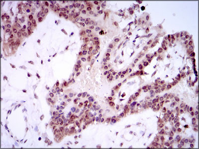 SPIB Antibody - IHC of paraffin-embedded ovarian cancer tissues using SPIB mouse monoclonal antibody with DAB staining.