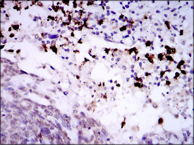SPIB Antibody - IHC of paraffin-embedded esophageal cancer with DAB staining.