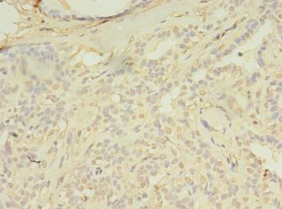 SPIC Antibody - Immunohistochemistry of paraffin-embedded human breast cancer using antibody at dilution of 1:100.