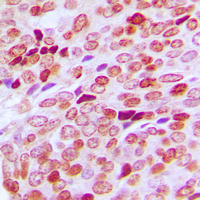 SPIN / SPIN1 Antibody - Immunohistochemical analysis of SPIN1 staining in human breast cancer formalin fixed paraffin embedded tissue section. The section was pre-treated using heat mediated antigen retrieval with sodium citrate buffer (pH 6.0). The section was then incubated with the antibody at room temperature and detected using an HRP conjugated compact polymer system. DAB was used as the chromogen. The section was then counterstained with hematoxylin and mounted with DPX.