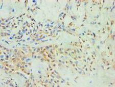 SPIN2B Antibody - Immunohistochemistry of paraffin-embedded human breast cancer using antibody at 1:100 dilution.