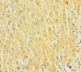 SPIN4 Antibody - Immunohistochemistry of paraffin-embedded human liver cancer using SPIN4 Antibody at dilution of 1:100