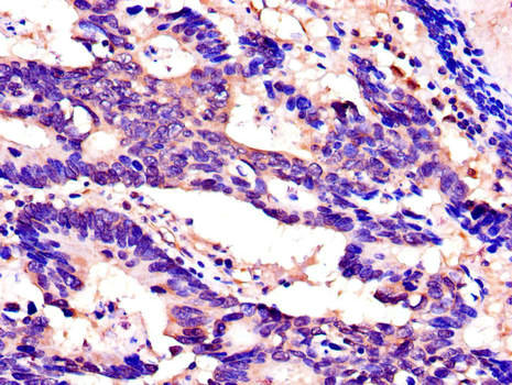 SPINK1 Antibody - Immunohistochemistry of paraffin-embedded human colon cancer using SPINK1 Antibody at dilution of 1:100