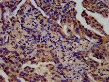 SPINK6 Antibody - Immunohistochemistry image at a dilution of 1:400 and staining in paraffin-embedded human lung cancer performed on a Leica BondTM system. After dewaxing and hydration, antigen retrieval was mediated by high pressure in a citrate buffer (pH 6.0) . Section was blocked with 10% normal goat serum 30min at RT. Then primary antibody (1% BSA) was incubated at 4 °C overnight. The primary is detected by a biotinylated secondary antibody and visualized using an HRP conjugated SP system.