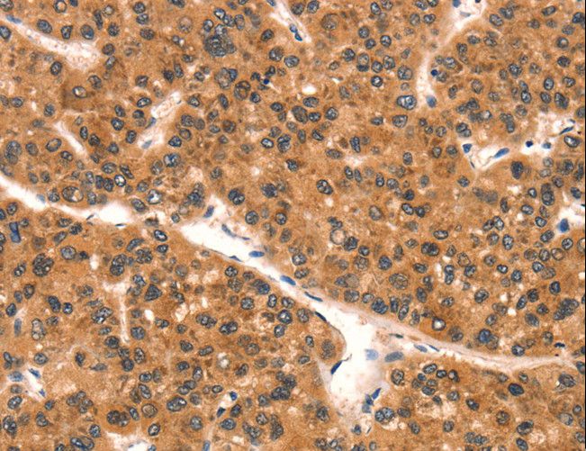SPINLW1 / EPPIN Antibody - Immunohistochemistry of paraffin-embedded Human liver cancer using EPPIN Polyclonal Antibody at dilution of 1:25.