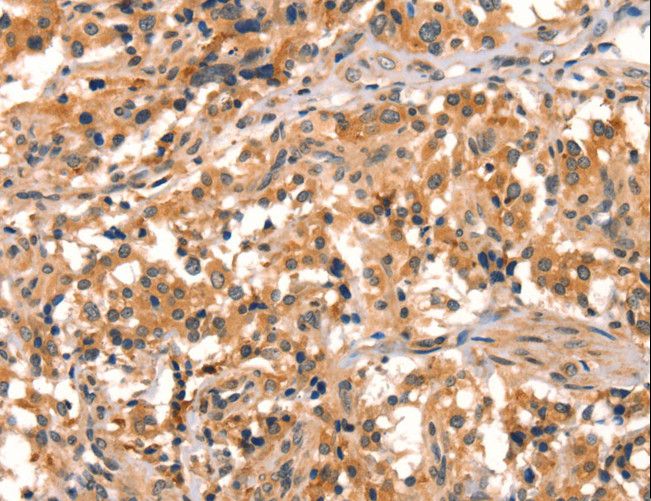 SPINLW1 / EPPIN Antibody - Immunohistochemistry of paraffin-embedded Human thyroid cancer using EPPIN Polyclonal Antibody at dilution of 1:25.