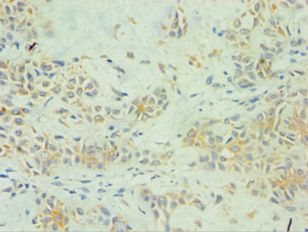 SPINT1 / HAI-1 Antibody - Immunohistochemistry of paraffin-embedded human breast cancer using antibody at 1:100 dilution.